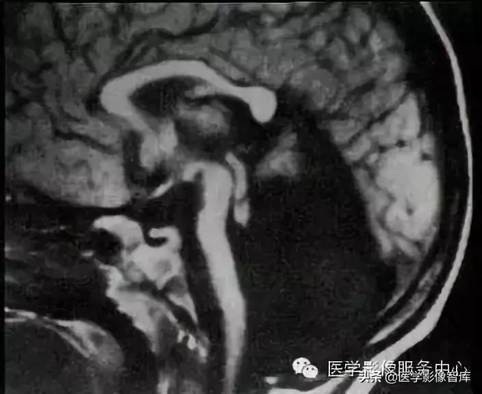 chiari畸形确诊,chiari畸形症状会一直有吗