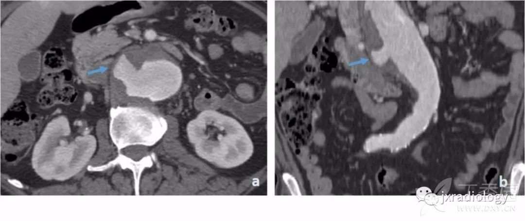 急性主动脉综合征报道,急性主动脉综合征症状
