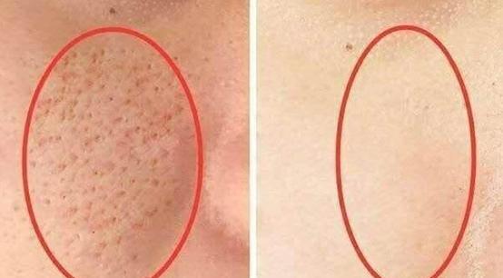 毛孔粗大的原因和解决方法,毛孔粗大原因及如何改善