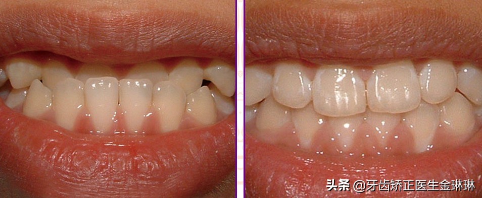 牙齿正畸前后变化大吗？带你看牙齿矫正变化图