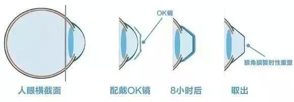 哪种ok镜透氧性比较好,隐形眼镜ok镜哪个好