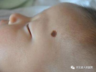 盘点新生儿特有的体征“符号”