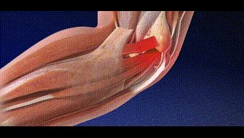 高尔夫球肘关节疼痛治疗,急性高尔夫球肘快速康复方法