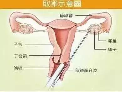女大学生卖卵：游走在学校厕所里的高薪工作。