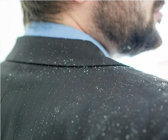 有头皮屑头痒用什么药治,头皮屑多头痒用啥洗发水