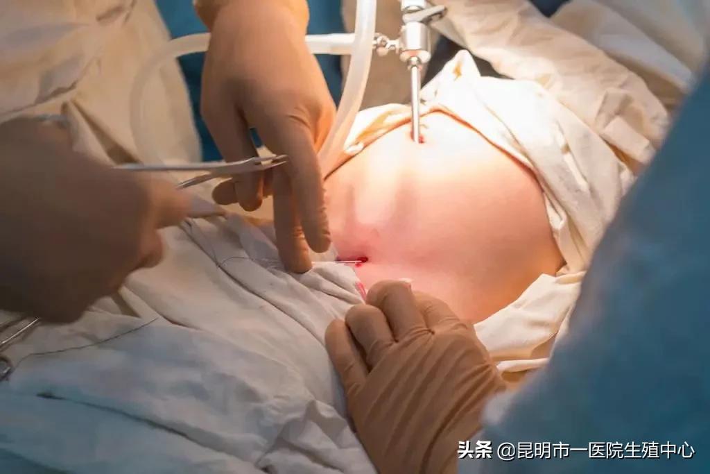 试管婴儿取完卵要注意什么,试管婴儿备孕知识科普