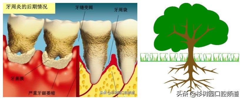 pmtc洗牙和普通洗牙有什么区别吗,39.9洗牙和150洗牙有什么区别