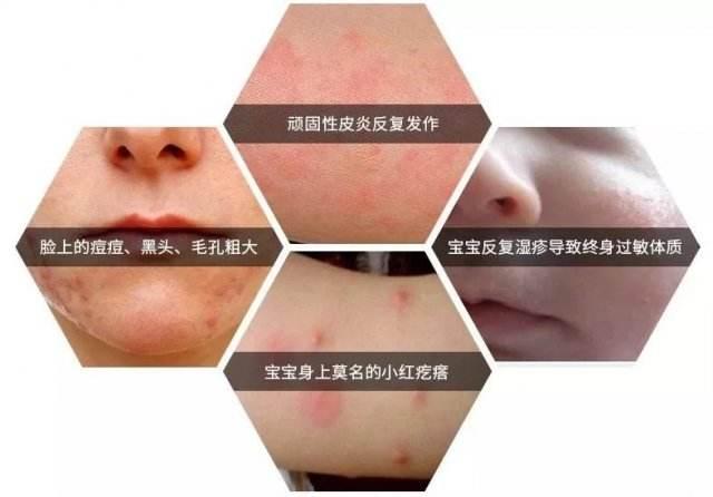 衣服经常洗总是穿上会痒,晚上脱了衣服就浑身痒是怎么回事