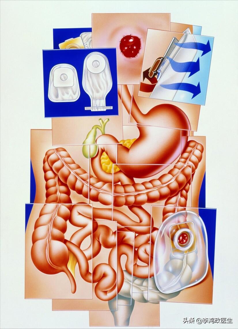 男子屁股痒,肛门瘙痒痔疮需要做肠镜吗