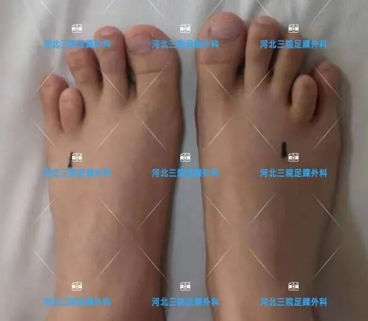 第四足趾短小怎么办,为什么第四脚趾短小