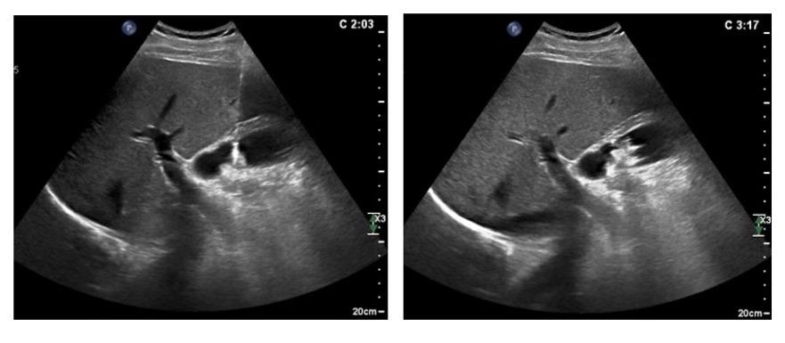 胆囊息肉消融保胆有效吗,胆囊息肉消融保胆有用吗