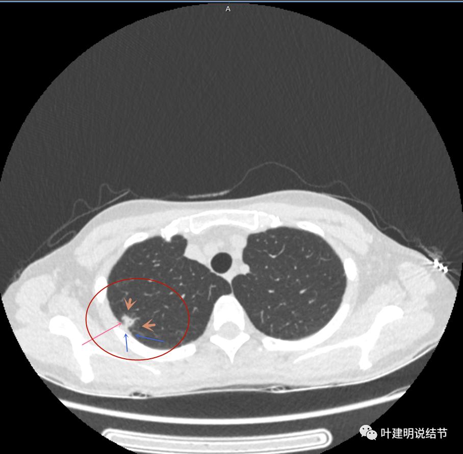 临床诊断孤立性肺结节,空洞型结节一般是什么性质