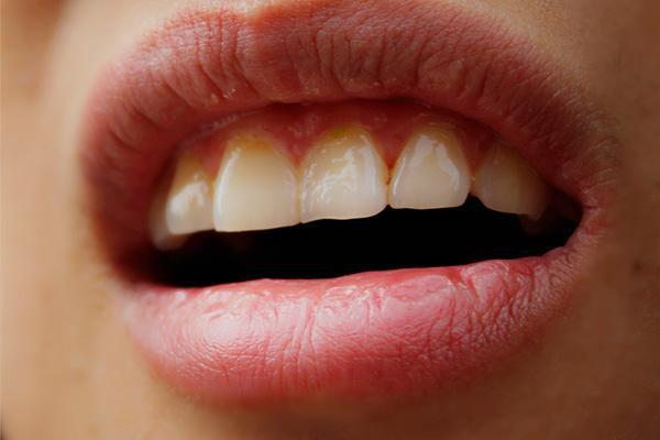 刷牙去牙垢牙结石小妙招,刷牙去除牙结石的方法