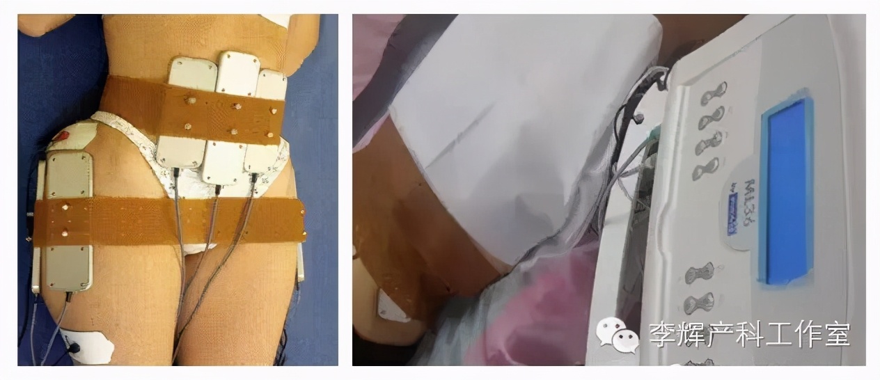 顺产后42天复查建议盆底康复治疗,产后42天复查医生要求做盆底康复