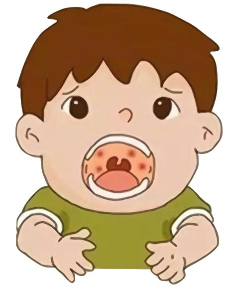 疱疹性咽峡炎有办法预防吗,疱疹性咽峡炎痊愈后要注意什么