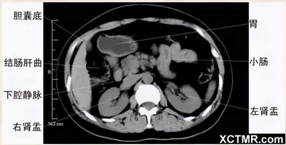 女性盆腔ct断层解剖结构图,女性盆腔脏器ct解剖