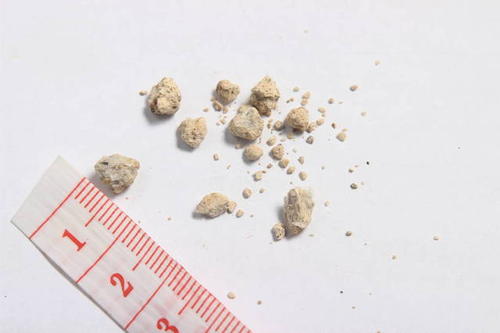 肾结石快速排石动作,肾结石7mm吃排石颗粒多久排下来