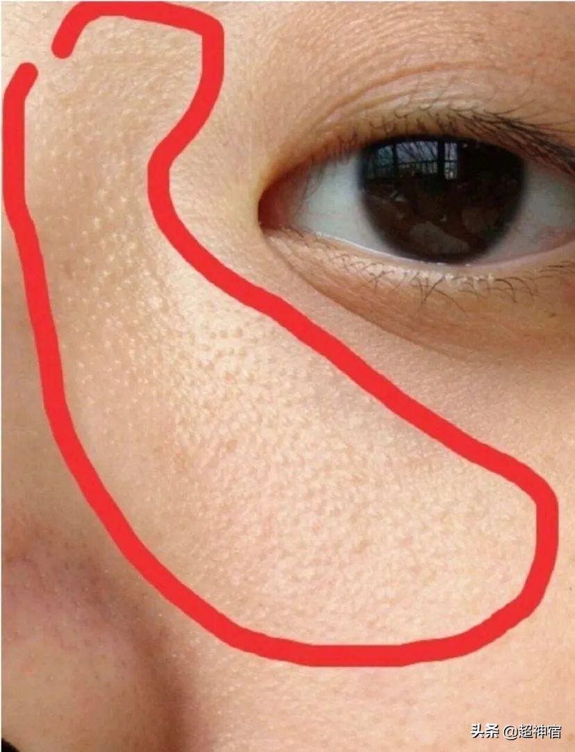 如何预防闭口长出并解决闭口问题,教你5个根治闭口粉刺方法