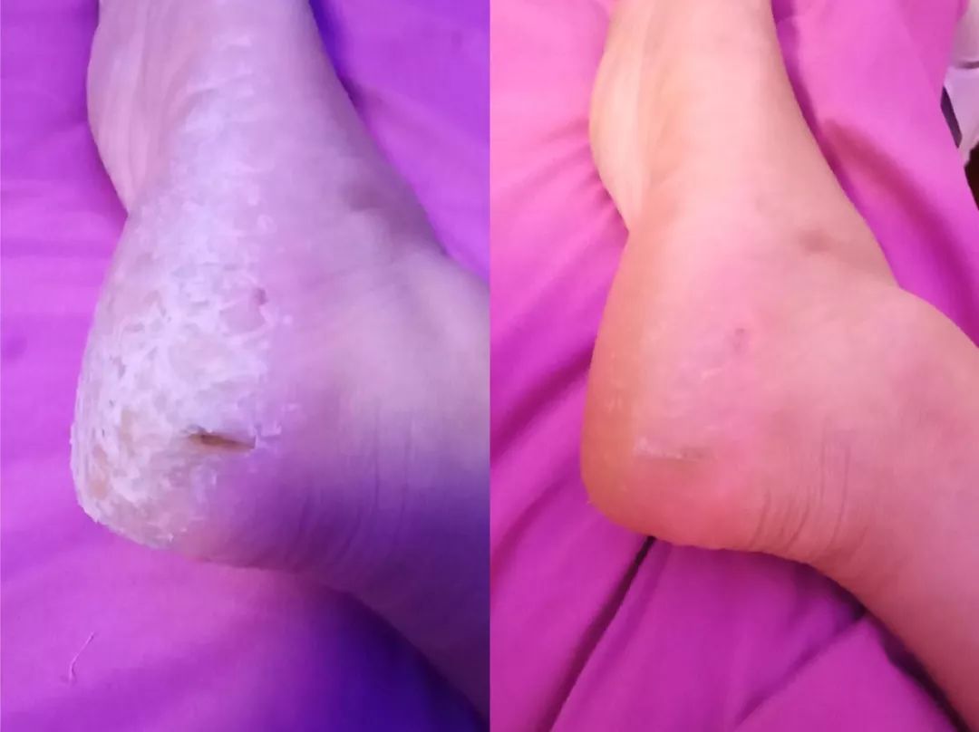 冬季皲裂膏预防脚后跟干裂好用的,上热门脚后跟干裂保湿霜