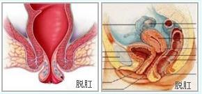 痔疮脱肛出血有肉球怎样消除,脱肛和痔疮肉球是一回事吗