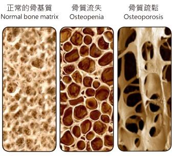 89.1%的类风湿患者都会骨密度减少，5年以上致残率几乎占一半