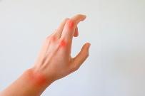 甲氨蝶呤必知的13个要点