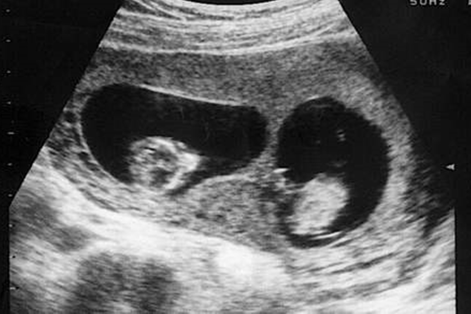 龙凤胎姐姐器官移植给弟弟,龙凤胎姐姐给弟弟移植器官