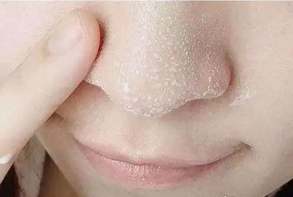 黑头多怎么办如何去除黑头,黑头贴去除顽固黑头