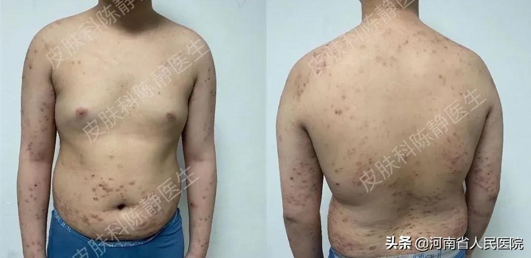 被痒吞噬的人们，是时候揭开这“湿疹”的真面目了