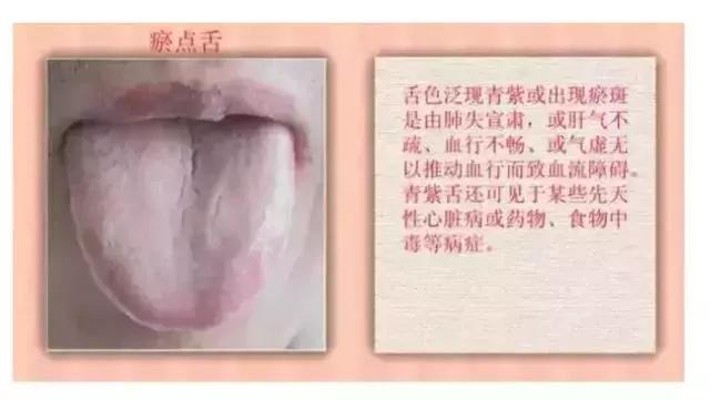 观舌识病22种舌诊图解大全,舌诊看舌头视频