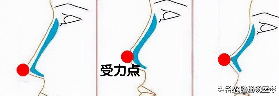 隆鼻整容老了会怎么样,隆鼻后老了