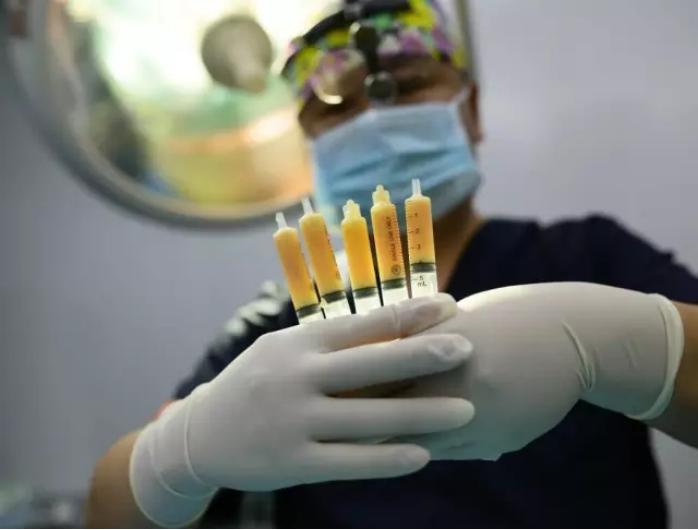 脂肪填充15天恢复照片脸型很满意,脂肪填充手术改善大小脸过程