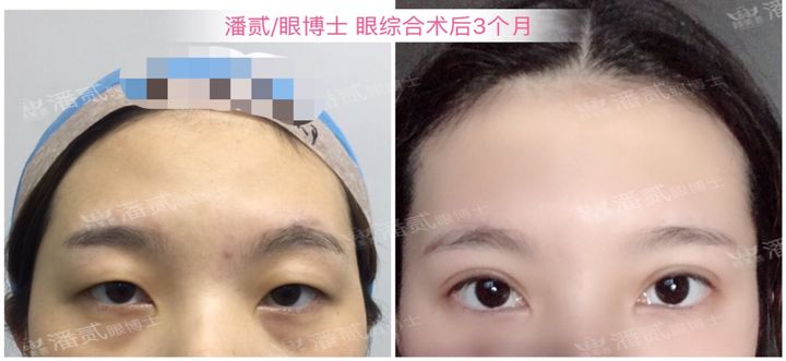原来双眼皮不好看有必要继续割吗,割双眼皮是不是越修复越难看