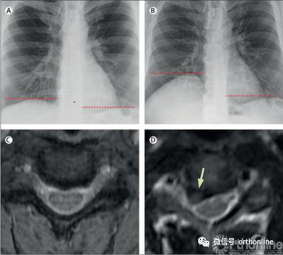 非单一类型颈椎病患者什么意思,颈椎病罕见吗好治吗