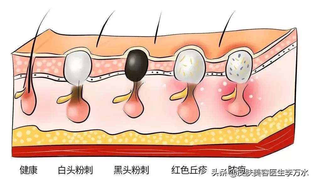 真假黑头教你如何正确去黑头,去黑头小妙招你的黑头有救了
