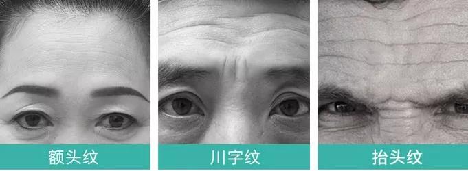 抬头纹暴露了你的年龄,抬头纹怎么消除才最快最有效孩子