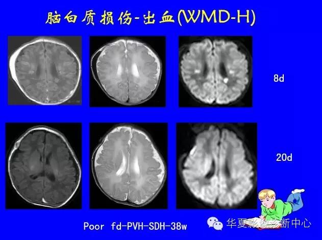 新生儿颅脑mri,新生儿颅脑mr报告模板