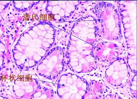 肠上皮化生是癌症吗,肠上皮化生什么意思