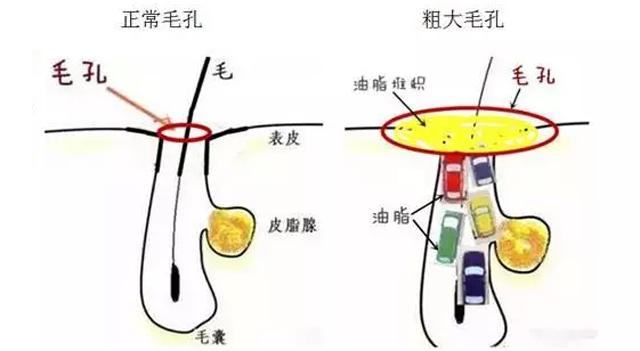 去粉刺收缩毛孔最好的方法,医美收缩毛孔最有效的方法