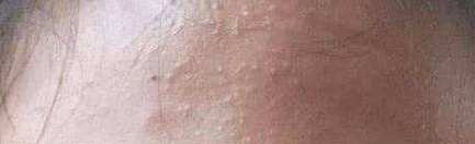 护肤清理闭口的方法,护肤长闭口怎么办