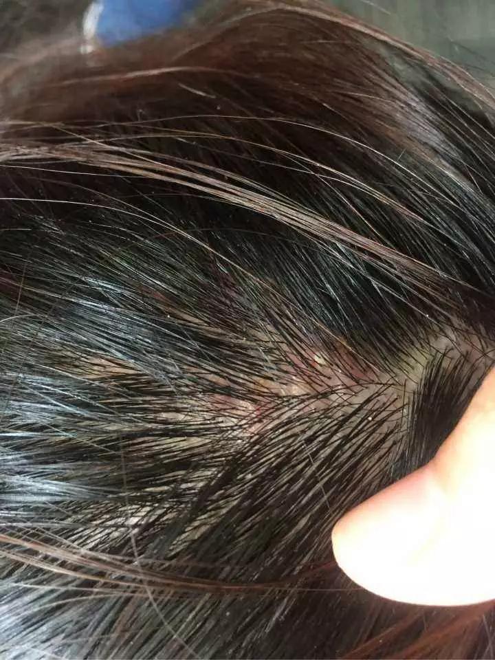 头皮屑过多怎么去除头皮屑,头皮屑特别多如何去掉头皮屑