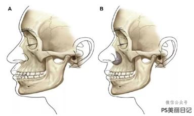 法令纹都是有什么方法可以去除,去法令纹最有效的办法明星
