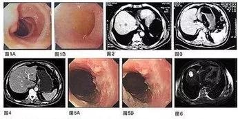 胃癌超过5年的真实案例,2021全球胃癌数据