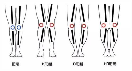 五个动作改善小腿外翻大象腿,矫正腿型小腿外翻合集