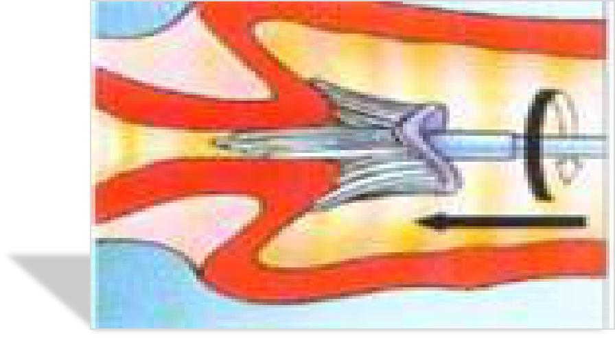 宫颈病变的诊断与治疗科普,宫颈低度病变如何治疗