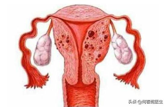 子宫内膜息肉，术前术后注意事项！