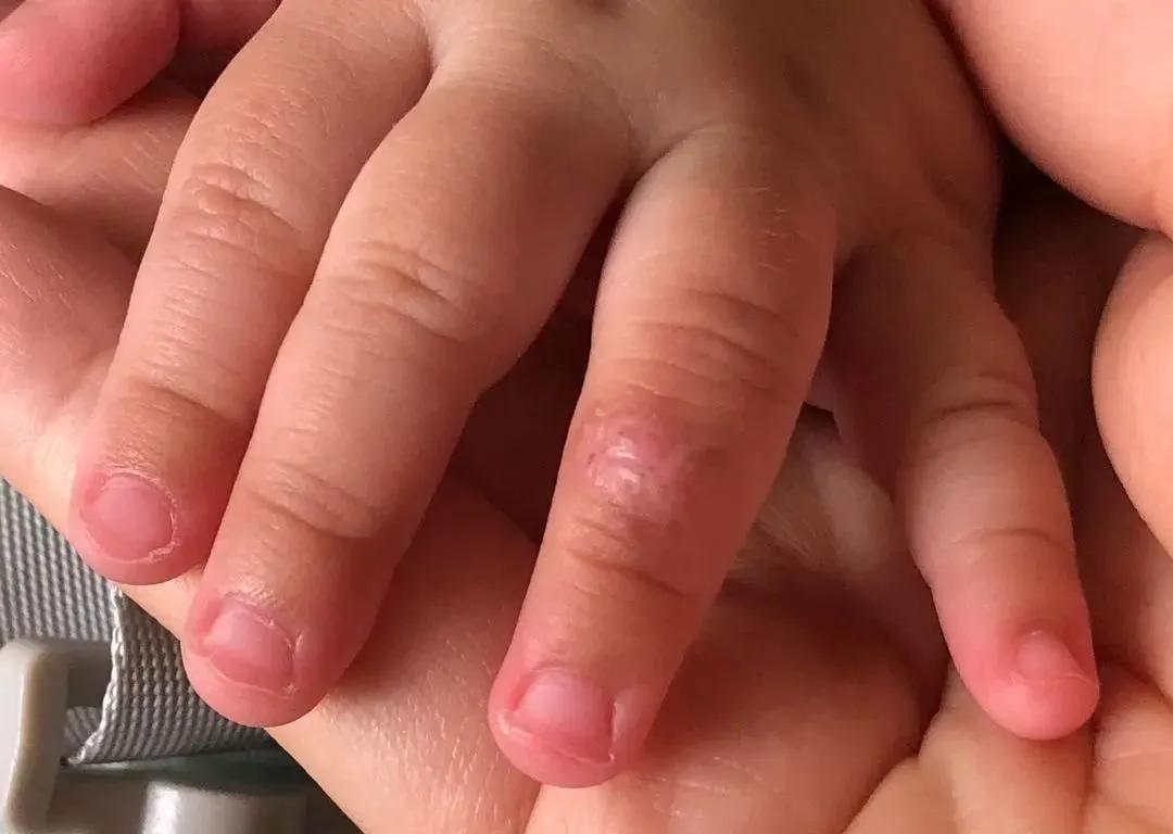 宝宝手指血管瘤治疗方法,手指头上长了个血管瘤怎么治疗