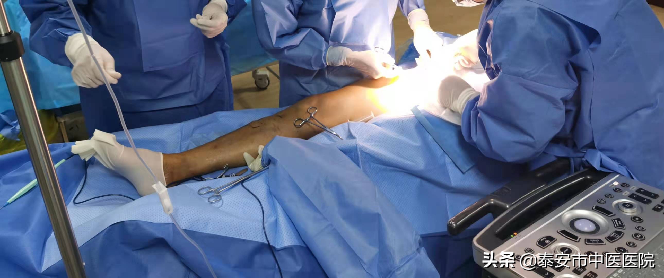 中医治疗下肢静脉曲张消除蚯蚓腿,微创闭合大腿根治静脉曲张过程