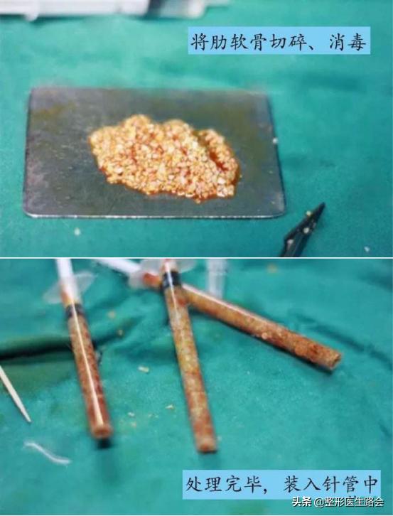 拉皮去法令纹怎么去除最安全永久,做拉皮能去除法令纹能坚持多久