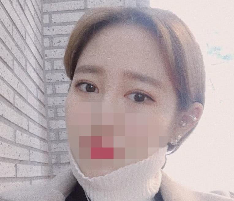 去皮去脂双眼皮恢复大概多长时间,全切双眼皮去皮去脂完全恢复视频